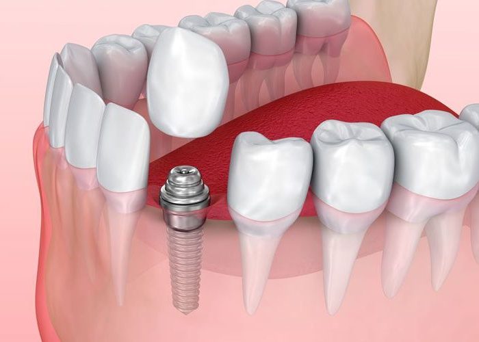 perawatan implan gigi