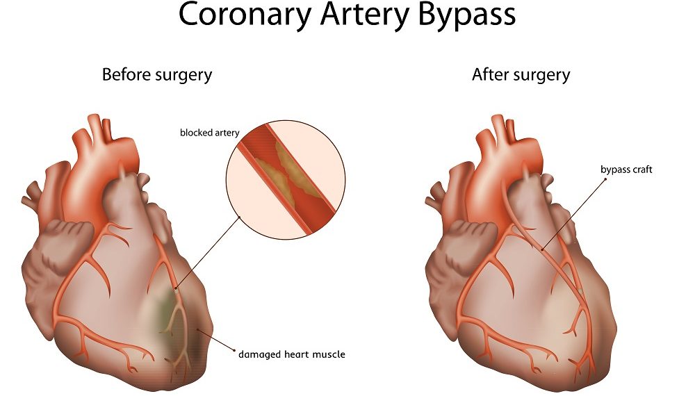 Coronary,Artery,Bypass,,Medical,Vector,Illustration.,Damaged,Heart,Muscle,,Blocked