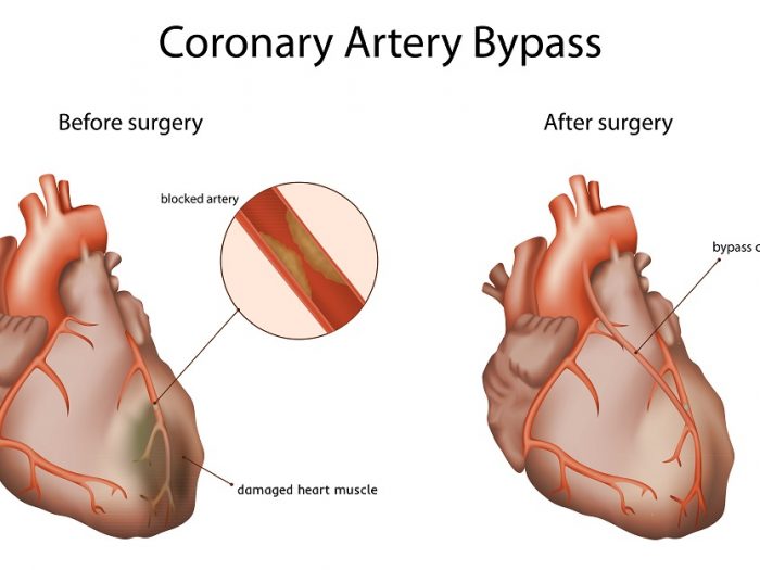 Coronary,Artery,Bypass,,Medical,Vector,Illustration.,Damaged,Heart,Muscle,,Blocked