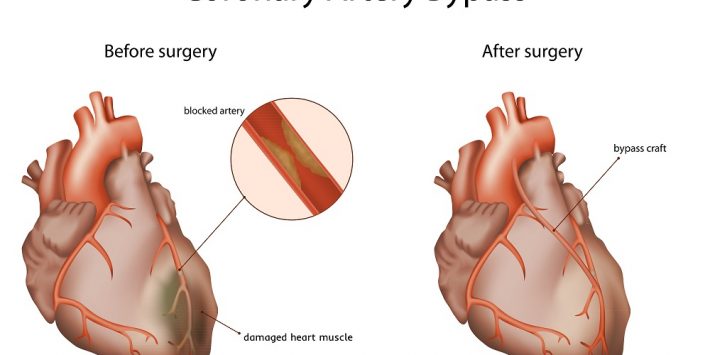 Coronary,Artery,Bypass,,Medical,Vector,Illustration.,Damaged,Heart,Muscle,,Blocked